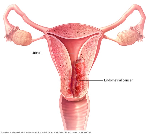 Any bleeding from the vagina post menopause is assumed to be cancer (Endometrial*) unless proven otherwise, and therefore should not be ignored.

Knowing this can lead to an early diagnosis, and treatment.

RT to create awareness. This could save a life ✅