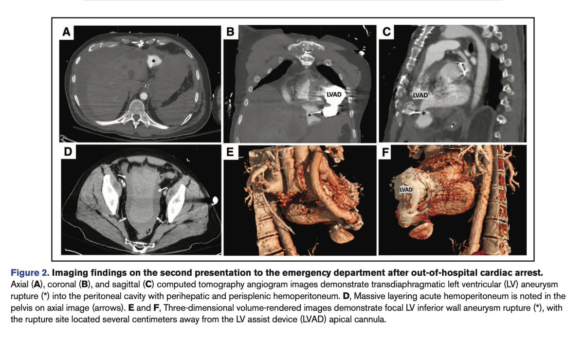 We just published a very interesting case in @CircImaging @CircAHA of a rare transdiaphragmatic LV aneurysm rupture in an LVAD patient causing intraperitoneal hemorrhage. Check it out! @noorchima14 @CarlyFabrizio @mashakir_md ahajournals.org/doi/10.1161/CI…