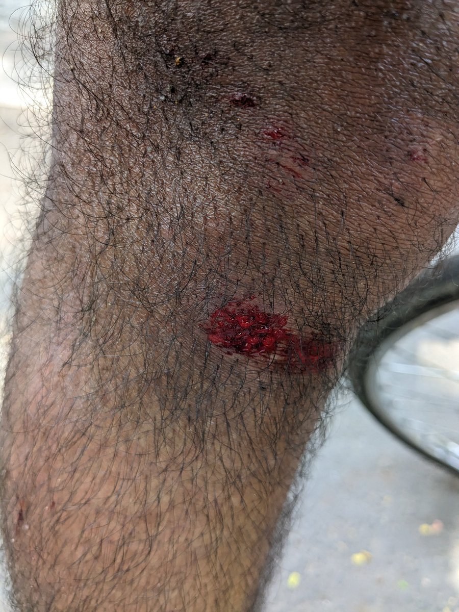 Iam a cyclist, was Hit and Run over by an Autorickshaw with Pilot driver at New Market Metrostation, Pillar No: A1453, nr. Malakpet Gunj Busstop.
Rash & Negligent driving (Intentional Hit & Run) by Autoricksaw along with Pilot driver today at 9:50 AM.
@CPHydCity
@hydcitypolice