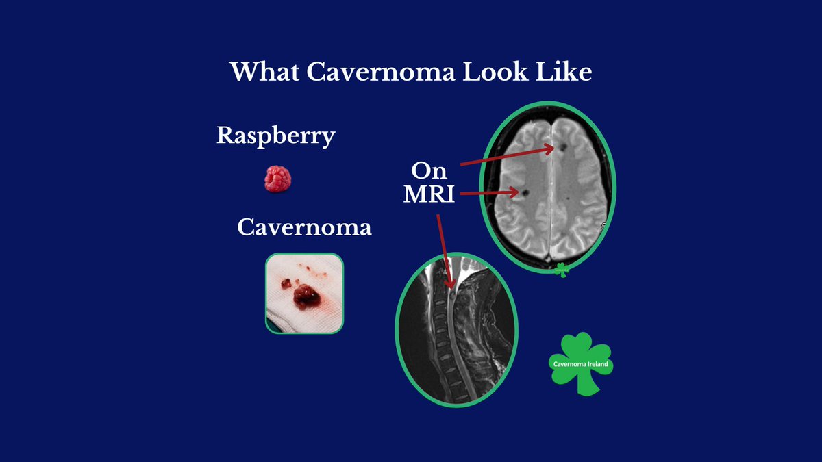 🤔What do they look like?
Cavernoma look like a raspberry.

It's filled with blood that flows slowly through abnormal blood vessels that are like 'caverns'.

They can be found in the brain and/or spinal cord.

#CavernomaAwareness #InternationalCavernomaAwareness #Angioma