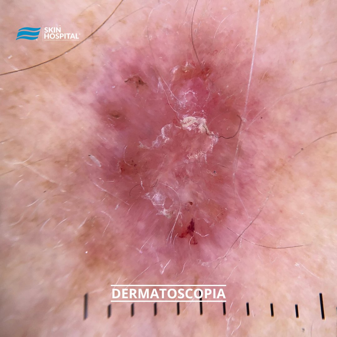 SkinHospital_mx's tweet photo. El cáncer de piel se debe retirar con márgenes de piel sana, dependiendo del cáncer los márgenes pueden ser desde 4mm a 2cm a la redonda.

LOOK GOOD &amp; FEEL GOOD

.
.
.
#cancer #Mujeres #CBC #dermatologia #skinhospital https://t.co/QIS5rzFBfG