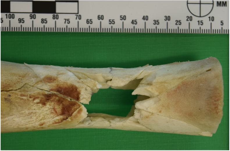 Did you know skeletal reconstructions post-ballistic impact can highlight characteristic fragmentation patterns?

Identifying failure mechanisms in skeletal tissue allows a deeper understanding of the effects of projectile impacts. More in #JFS article: doi.org/10.1111/1556-4…