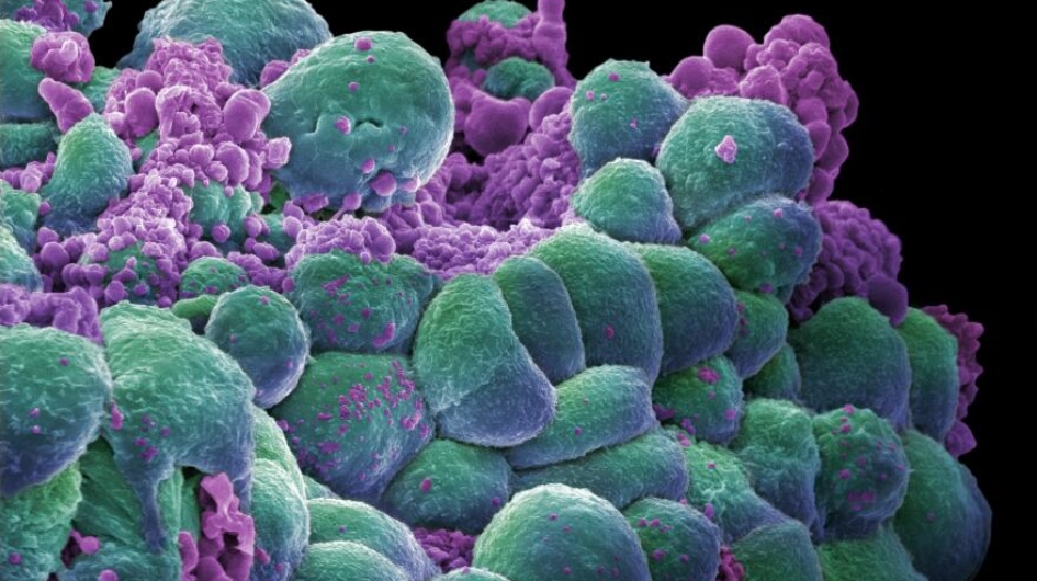 📣We welcome <a href="/NICEComms/">NICE</a> recommendation of olaparib for use on <a href="/NHSEngland/">NHS England</a> for #OvarianCancer maintenance treatment after previous treatment.

The ICR and <a href="/royalmarsdenNHS/">The Royal Marsden NHS Foundation Trust</a> showed the effectiveness of olaparib for various indications in adults with #BRCA 1/2 mutations.