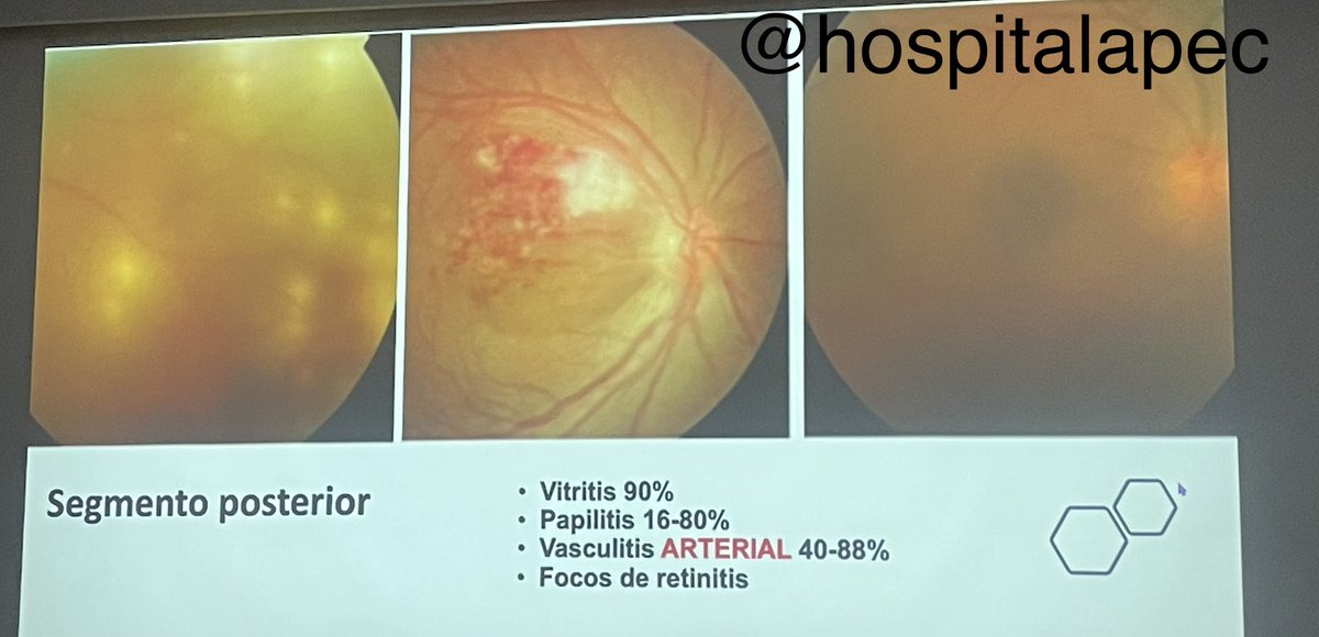 Clase hoy Enfermedad Behcet
@HospitalApec 
Enfermedad inflamatoria multisistémica.
La uveítis, 1” manifestación 10-15%
👁️👁️panuveítis remitente recidivante y vasculitis retina
Hombres >grave y peor pronóstico visual
Inmunosupresión siempre involucro segmento posterior #uveitis