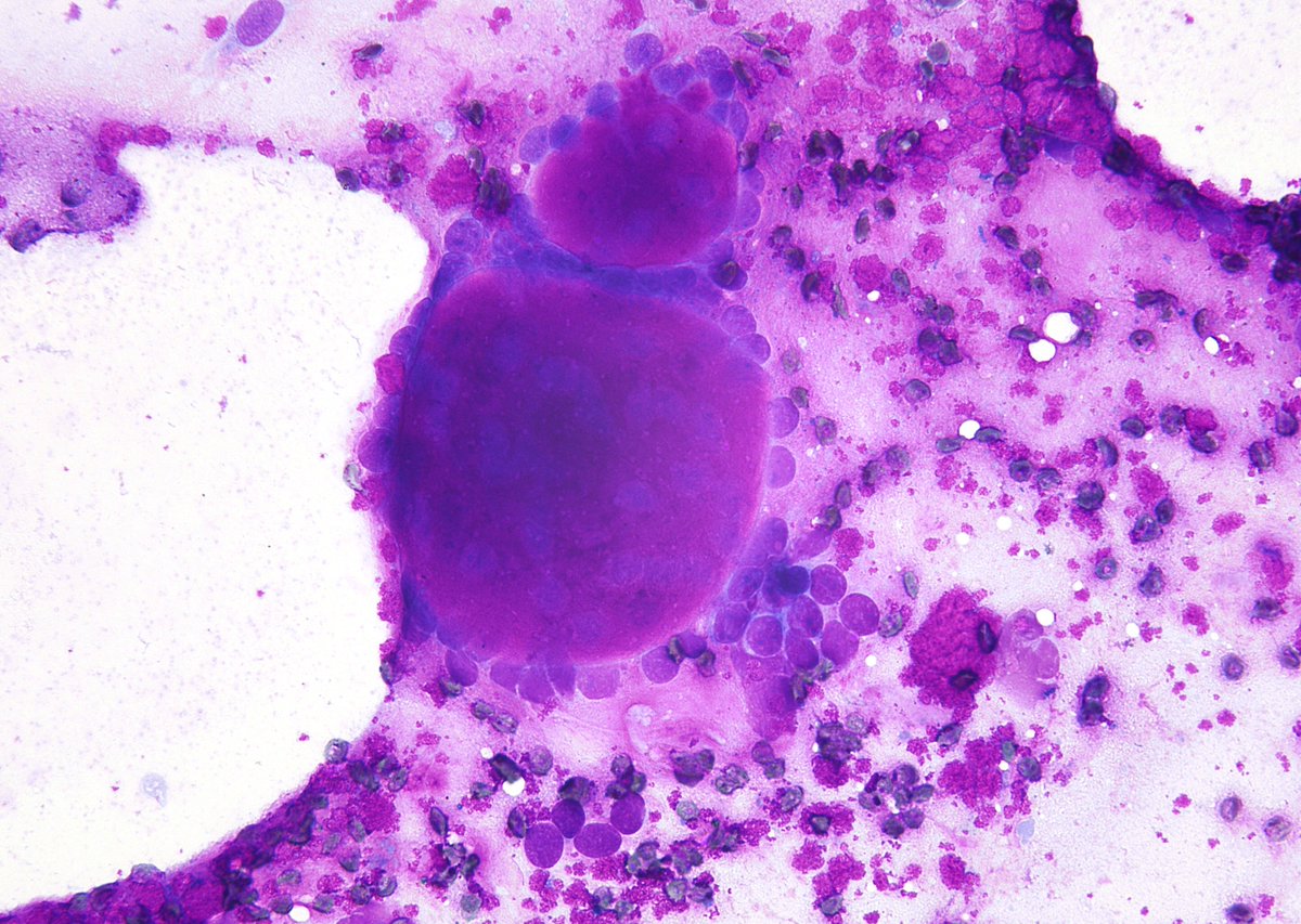'Cogwheels' - Soft tissue FNA from a metastatic 'Adenoid Cystic Carcinoma'.