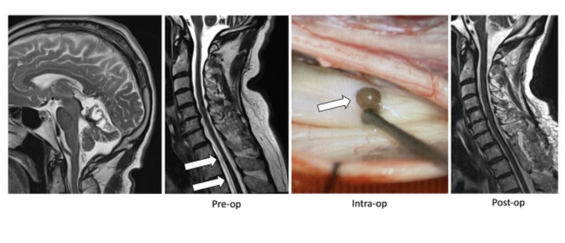 WouterSchievink's tweet image. Normal cisternography does not “rule out” a #CSFleak. 74 y-o man suffering with orthostatic headaches since 1990s. 2011: MRI showed #superficialsiderosis and LP showed “orange” CSF. Cisternogram normal. 2023: unable to walk and self-cath x6/day. Ventral leak at T1-2. #SIH