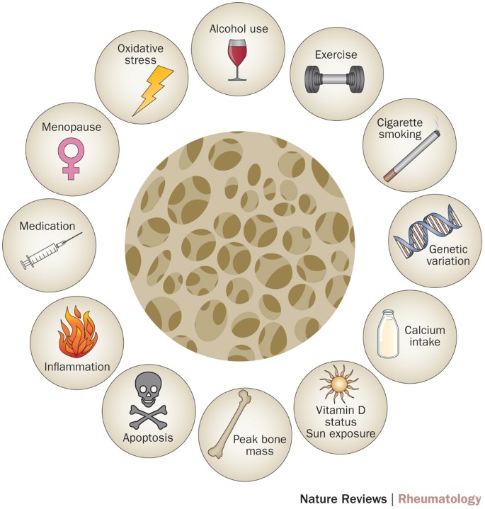 Factores que influyen en el desarrollo de la osteoporosis.
✅ Nivel de actividad física
✅ Estado de vitamina D/exposición al sol
✅ Alcohol
✅ Ingesta de calcio
✅ Fumar
✅ Menopausia
✅ Medicación
✅ Genética
✅ Estrés oxidativo
✅ Inflamación