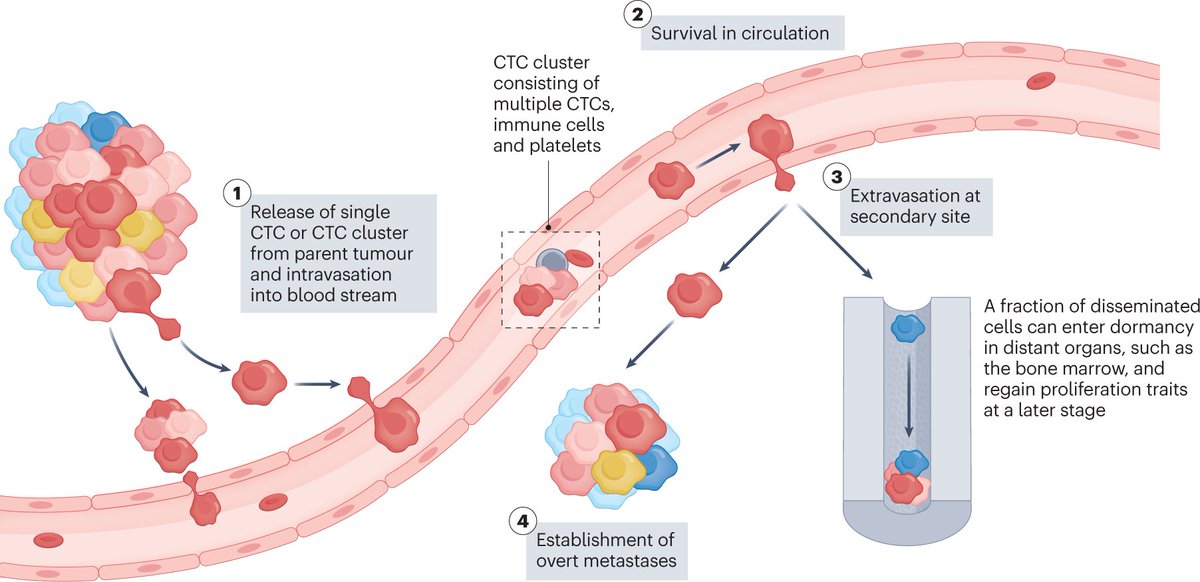 cancerscnews's tweet image. 🩺 @rachlawrence101 and colleagues at @QMBCI &amp;amp; beyond discuss the potential of circulating tumor cells (#CTCs) to facilitate early detection of clinically relevant cancers, and the technological advances that might improve CTC capture. 

@NatRevClinOncol: go.nature.com/42mXPd2