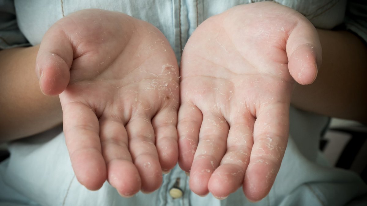 LivingBeyondBC's tweet photo. The chemotherapy drug capecitabine is often used to treat #breastcancer. New research presented at #ASCO23 reveals that diclofenac, an easily available topical gel, can help prevent hand-foot syndrome, a challenging side effect of capecitabine. Learn more: https://t.co/Tt1L0ixj7S https://t.co/L0nFtHXiWb