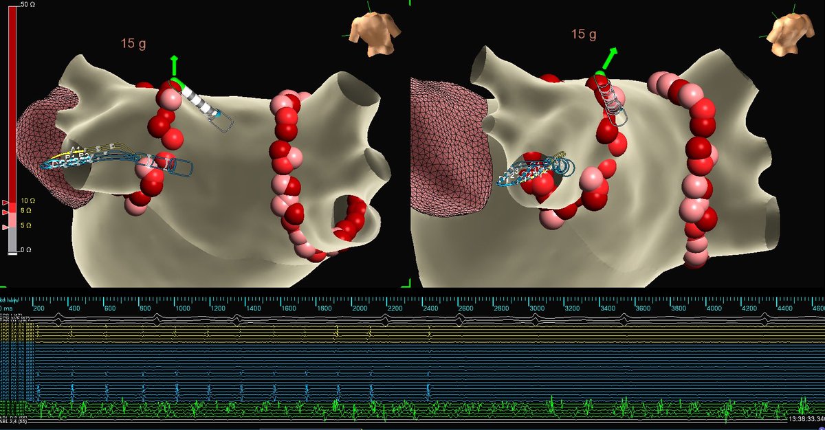 mike_lean's tweet image. Always nice to see the PVs isolate before finishing a WACA: a nod to the segmental PVI. Is this more likely in certain subsets of patients? Paroxysmal AF patients with less advanced remodeling?

Thank you @MonicaYLo &amp;amp; LR team for hosting, in person this time! Great case/workflow.