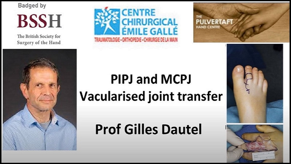 ipokrate's tweet photo. PIPJ and MCPJ Vascularised Joint Transfer

Watch and learn today from the Pulvertaft Videos series on "The patient-surgeon relationship, how it relates to outcome and he role of communication."

https://t.co/Mnm7UZm5WM

#ipokrate #conference #doctor https://t.co/KTdXsQDsjB