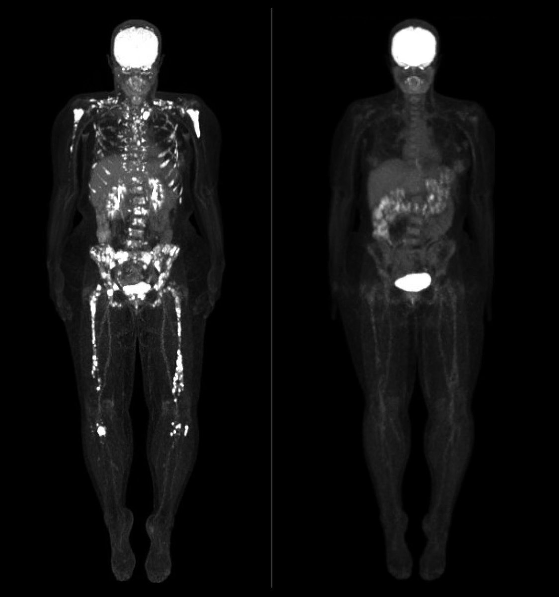 The patient, her husband, the PA and I all welled up with tears as these images came up.    This is before and after.   Image on the left shows disease everywhere.   The right side is what complete remission looks like.  #mmsm ⁦<a href="/TischCancer/">The Tisch Cancer Institute</a>⁩ (*with permission from patient)