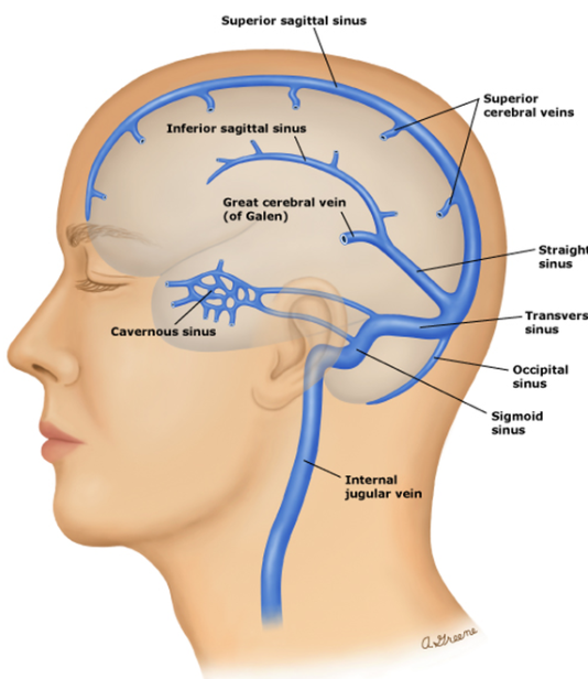 Cerebral vein thrombosis
  
Etiology: 
Idiopathic 
Hypercoaguable states 
Polycythemia vera 
Behcet's
Essential thrombocythemia 
Paroxysmal nocturnal hemoglobinuria
Asparaginase for ALL
J&J???

Presentation:
Vomiting
Papilledema
Headache

Diagnosis: 
MRI with MRV
CT venography