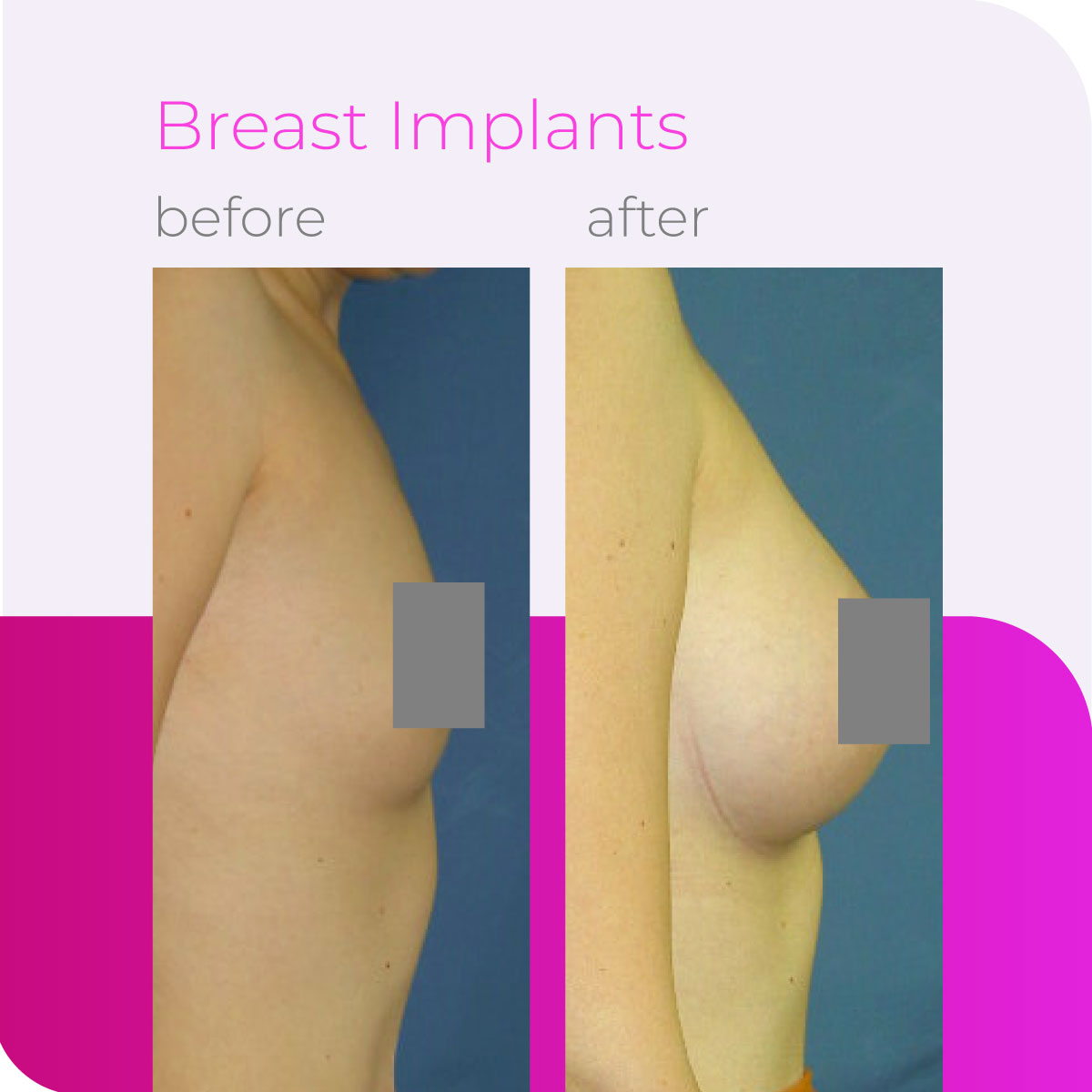 drfardadf's tweet photo. Experience the life-changing transformation of Breast Implants. Achieve fuller, beautiful curves and renewed confidence with our expert procedure. With personalized guidance and a focus on your safety and comfort, our dedicated team is here to support you every step of the way. https://t.co/afYyCumBjA