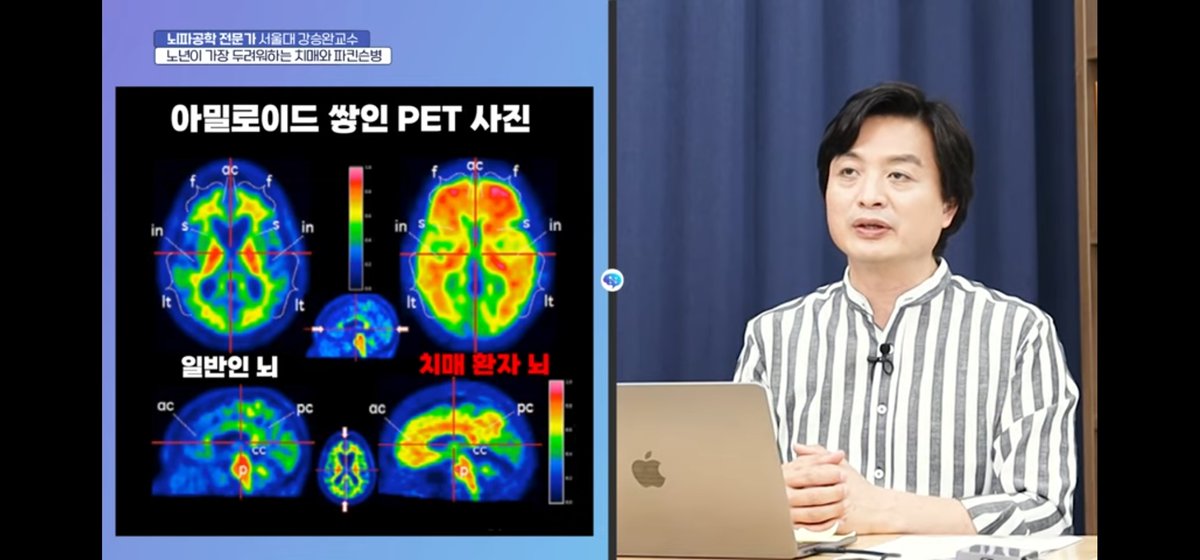 iMedisync's tweet photo. 뇌파 공학 전문가

정상인의 뇌와 알츠하이머, 파킨슨 병을 앓고 있는 사람의 뇌는 어떤 차이가 있을까?

🧠뇌파의 차이
🧠Amyloid Pet 차이

자세한 내용은 유튜브
"강승완의 뇌비게이션"에서 확인해주세요.

#정상인 #치매 #알츠하이머 #파킨슨 #뇌파 #amyloidpet #Brainwave #아밀로이드플라그 https://t.co/bQrA7MGoLK