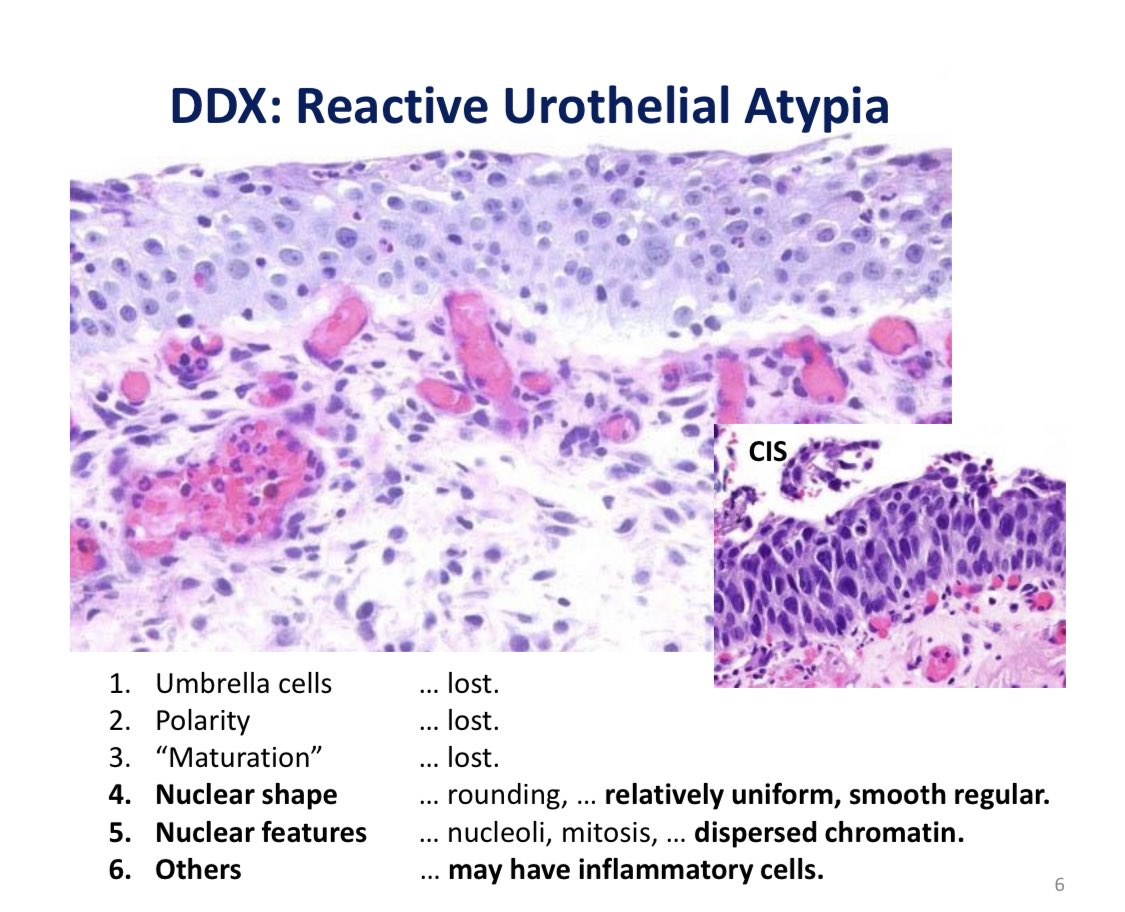 zahrah_tawil's tweet photo. The tricky business in bladder on a daily basis .. figuring out whether it is neoplastic or not #APIAP2023 #GUPath https://t.co/OHHE2fGW1y