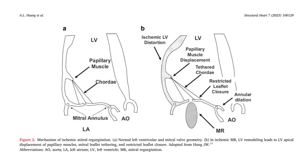 Serginho1409's tweet photo. Review Article
Secondary Mitral Regurgitation: Cardiac Remodeling, Diagnosis,
and Management
https://t.co/Y1cZfR65D8
#echfirst #mitral #Cardiology #CardioEd #cardiotuiter @Mitrovalvology https://t.co/bN4XkSfx2V