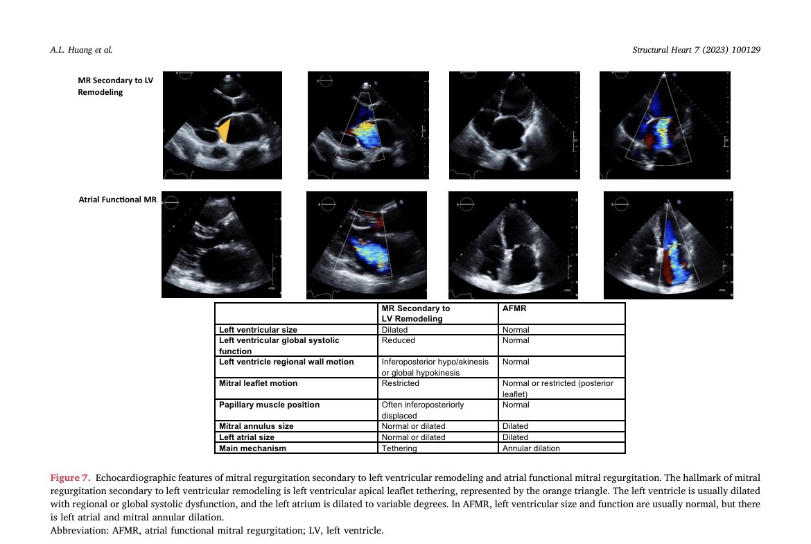 Sergio Moreno M (@serginho1409) on Twitter photo Review Article
Secondary Mitral Regurgitation: Cardiac Remodeling, Diagnosis,
and Management
doi.org/10.1016/j.shj.…
#echfirst #mitral #Cardiology #CardioEd #cardiotuiter <a href="/Mitrovalvology/">Valva Mitralis</a> Review Article
Secondary Mitral Regurgitation: Cardiac Remodeling, Diagnosis,
and Management
doi.org/10.1016/j.shj.…
#echfirst #mitral #Cardiology #CardioEd #cardiotuiter <a href="/Mitrovalvology/">Valva Mitralis</a>