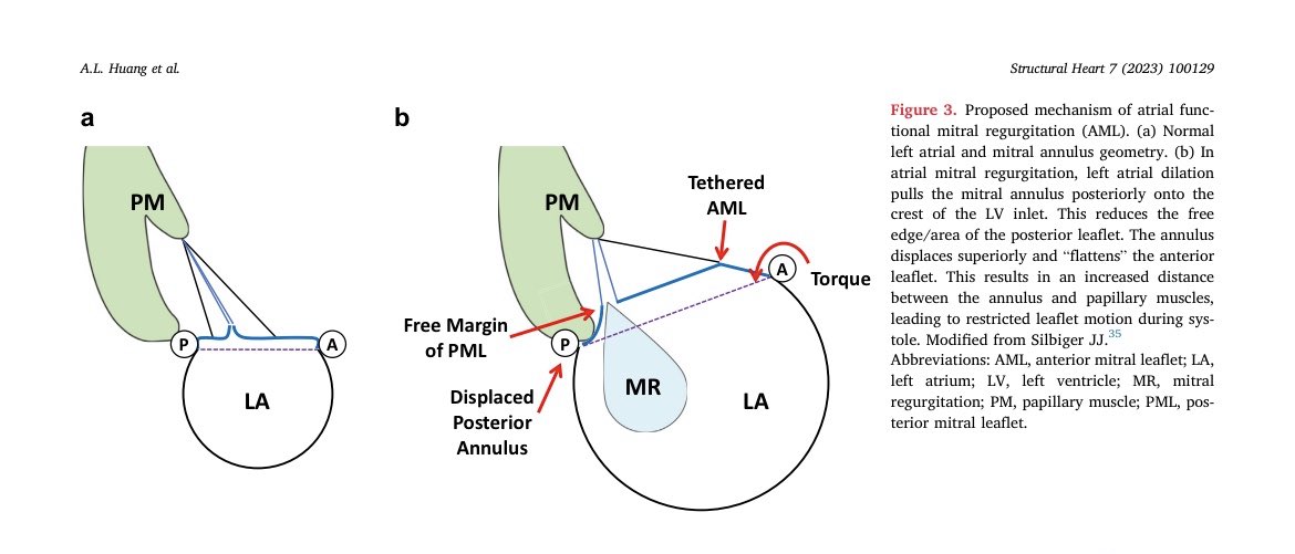 Serginho1409's tweet photo. Review Article
Secondary Mitral Regurgitation: Cardiac Remodeling, Diagnosis,
and Management
https://t.co/Y1cZfR65D8
#echfirst #mitral #Cardiology #CardioEd #cardiotuiter @Mitrovalvology https://t.co/bN4XkSfx2V