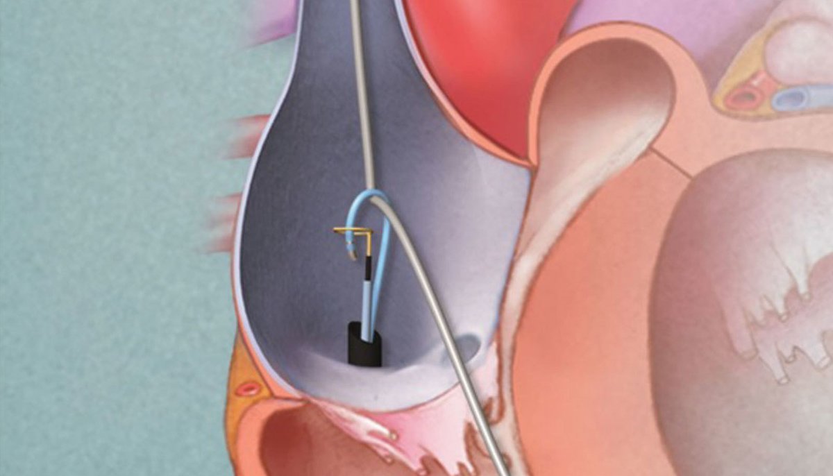 MayoClinicCV's tweet image. Interested in the topic of cardiovascular implantable electronic devices? #CIED Join @MayoClinic on June 14th, from 6-7pm CT for our 3rd Lead Extraction Workshop Webinar. Register now to secure your spot! 
mayocl.in/3oQ4s9Y