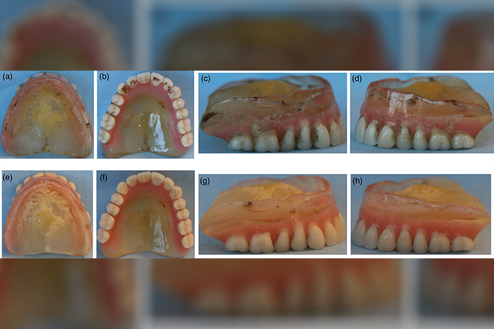 Now online in the <a href="/joprosthodont/">Journal of Prosthodontics</a>, an Open Access Review article on denture stomatitis. This interdisciplinary clinical review outlines the etiopathogenesis, clinical features, and management strategies of denture stomatitis from an interdisciplinary perspective.