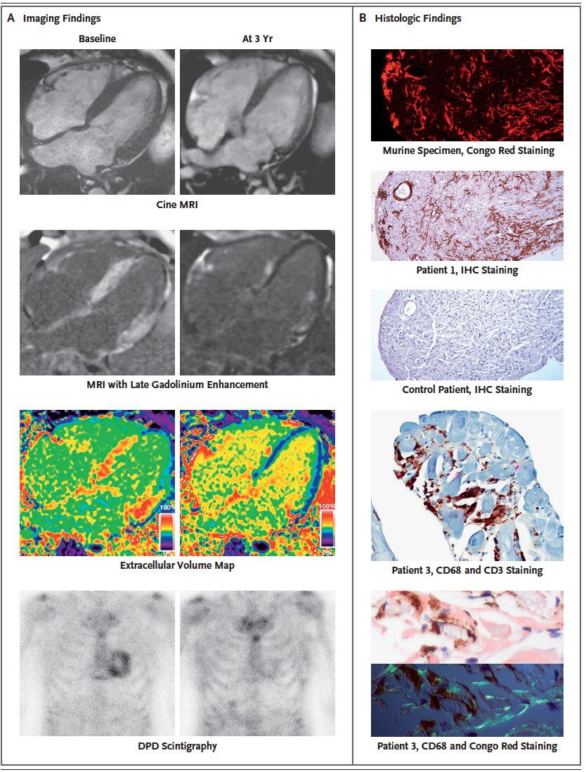 That's pretty striking 
Reversal of amyloidosis cardiomyopathy in 3 individuals who had developed anti-ATTR amyloid antibodies
nejm.org/doi/full/10.10… <a href="/NEJM/">NEJM</a> <a href="/MariannaFonta11/">Marianna Fontana</a>