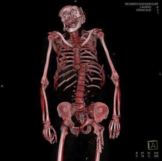 MorbidKnowledge's tweet photo. Virtual autopsy of a 50-year-old man who was run over by a train. https://t.co/XRDi3NawBf