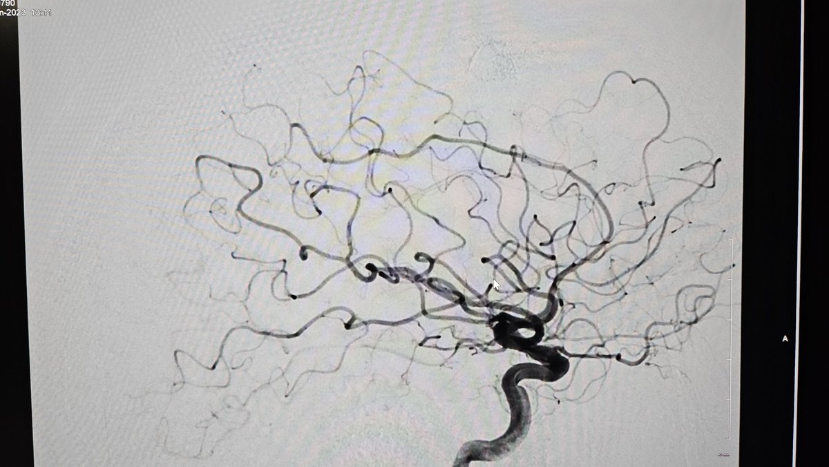 Edward Duckworth, MD, MS (@eamdmd) on Twitter photo Ruptured. Curable with embolization alone? I presented this case at Sun Valley Cerebrovascular Conference & many skeptics spoke up. Just performed 2nd control angio 1.5 yr later with no trace of lesion. #avm #embolization #embocure #radial #neurointervention <a href="/StLukesHealth/">St. Luke's Health System</a> Ruptured. Curable with embolization alone? I presented this case at Sun Valley Cerebrovascular Conference & many skeptics spoke up. Just performed 2nd control angio 1.5 yr later with no trace of lesion. #avm #embolization #embocure #radial #neurointervention <a href="/StLukesHealth/">St. Luke's Health System</a>