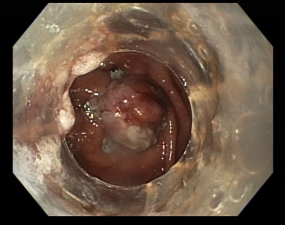 Back from a #GITwitter holiday 🙂 … Pt referral for non-healing GC fistula post PEG removal. Treated with Padlock OTS clip by @STERISEndoscopy . Good outcome! @EndoCollabcom @ASGEendoscopy