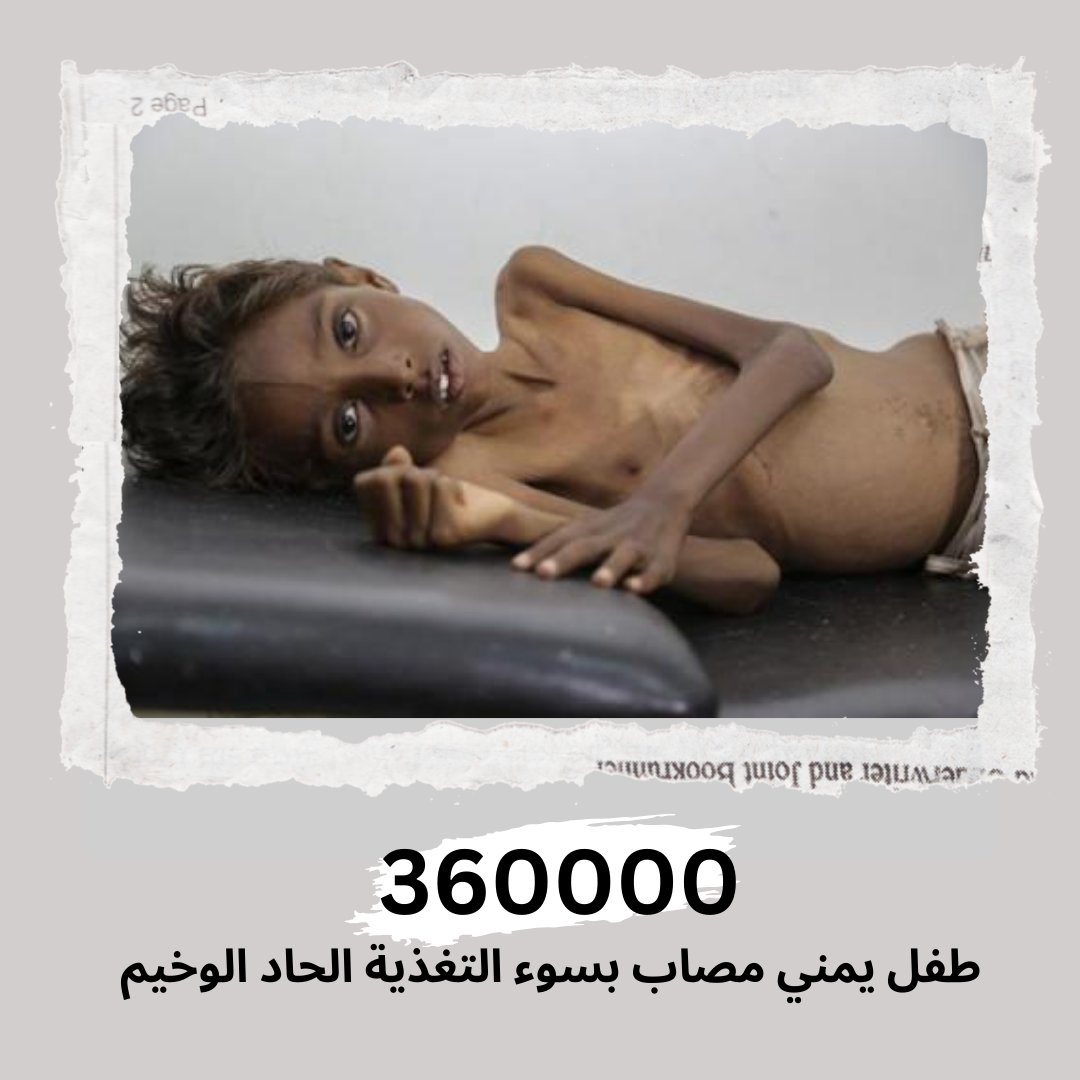 According to UNICEF statistics, 360,000 Yemeni children suffer from severe acute malnutrition.
#World_Food_Safety_Day #Yemen