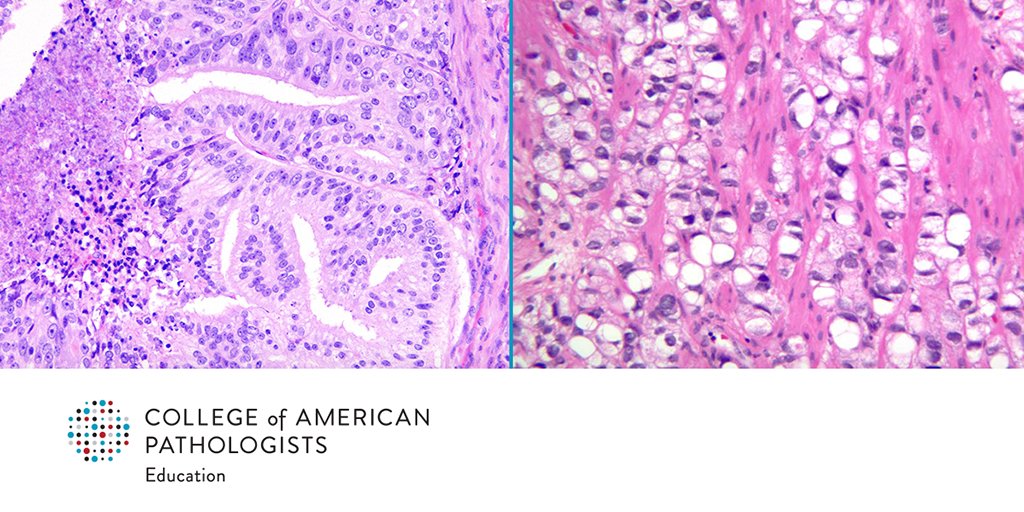Grow your skills in characterizing prostate disease. Learn best practices for using the Gleason Grading System. fal.cn/3yUpv