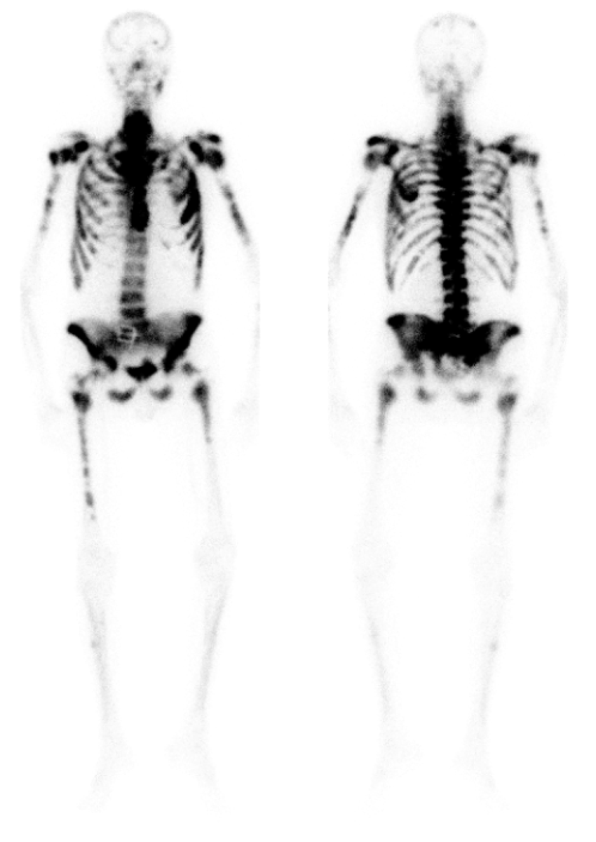 Random non-PSMA question!  What experience do people have treating patients with a superscan using Ra-223.  Asked about treating this patient, and there is obvious concern for marrow toxicity.  Borderline Hgb at baseline.  Also pre-chemo, so PSMA isn't an alternative. Thoughts?