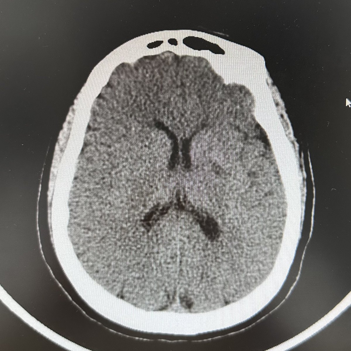 daigaole's tweet photo. The third attempt was to employ Stentriever, and at the same time, Tirofiban was administered. Waiting for about 10 minutes, forward blood flow can be maintained well. This time, the stent was not retracted directly, but reloaded into micro-catheter, then withdrawn with MC. The blood flow finally reached TICI 3.  The next day, the CT image was reviewed with a small infarction lesion, NIHSS 2 points.