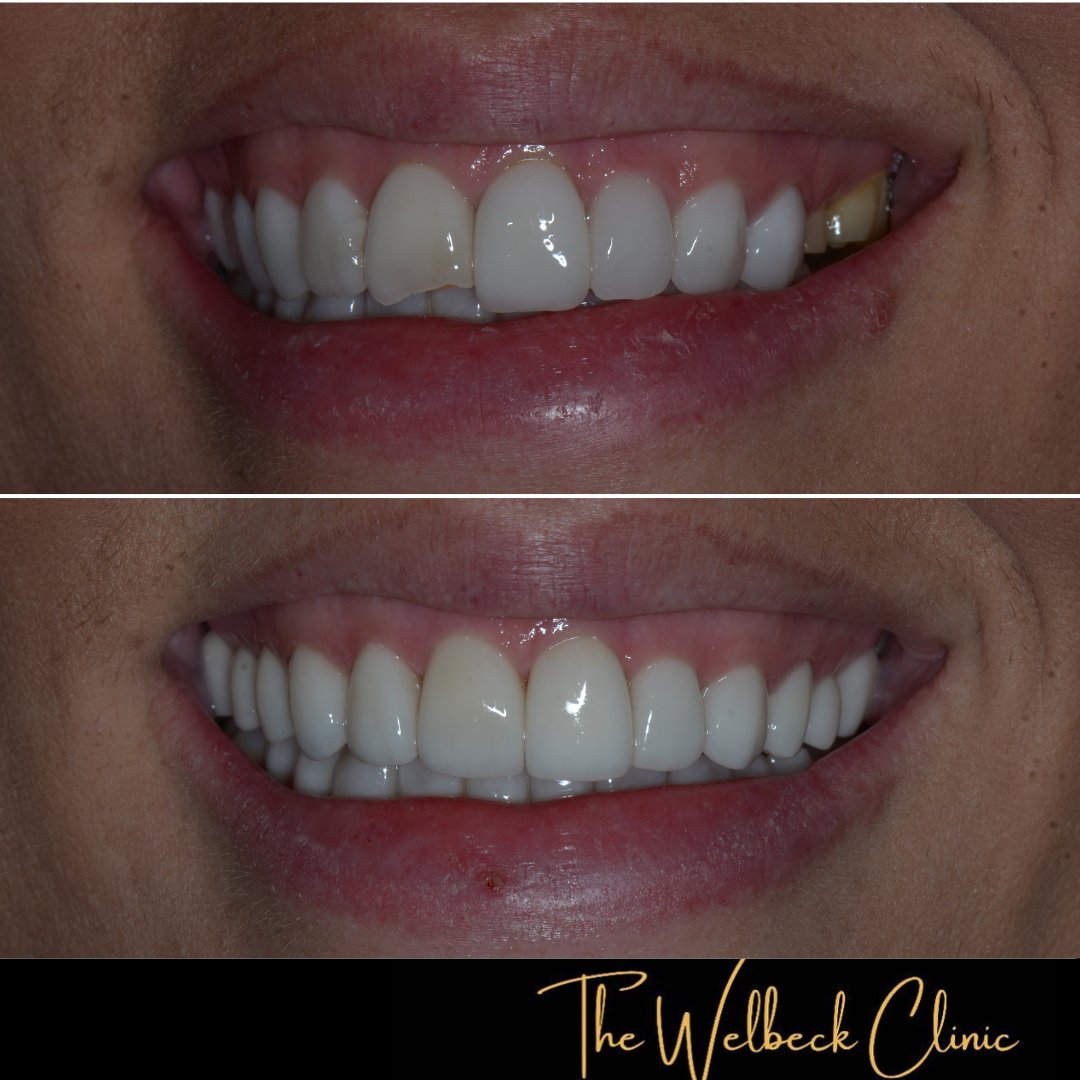 A close up look at this case of new veneers
Drilaty replaced the existing veneers, placing 12 new veneers in total to give the patient a brighter, fresher smile.  
To book a consultation contact us on 0207 486 8100
 #veneers #london #marylebone #cosmeticdentistry #harleyst #smile