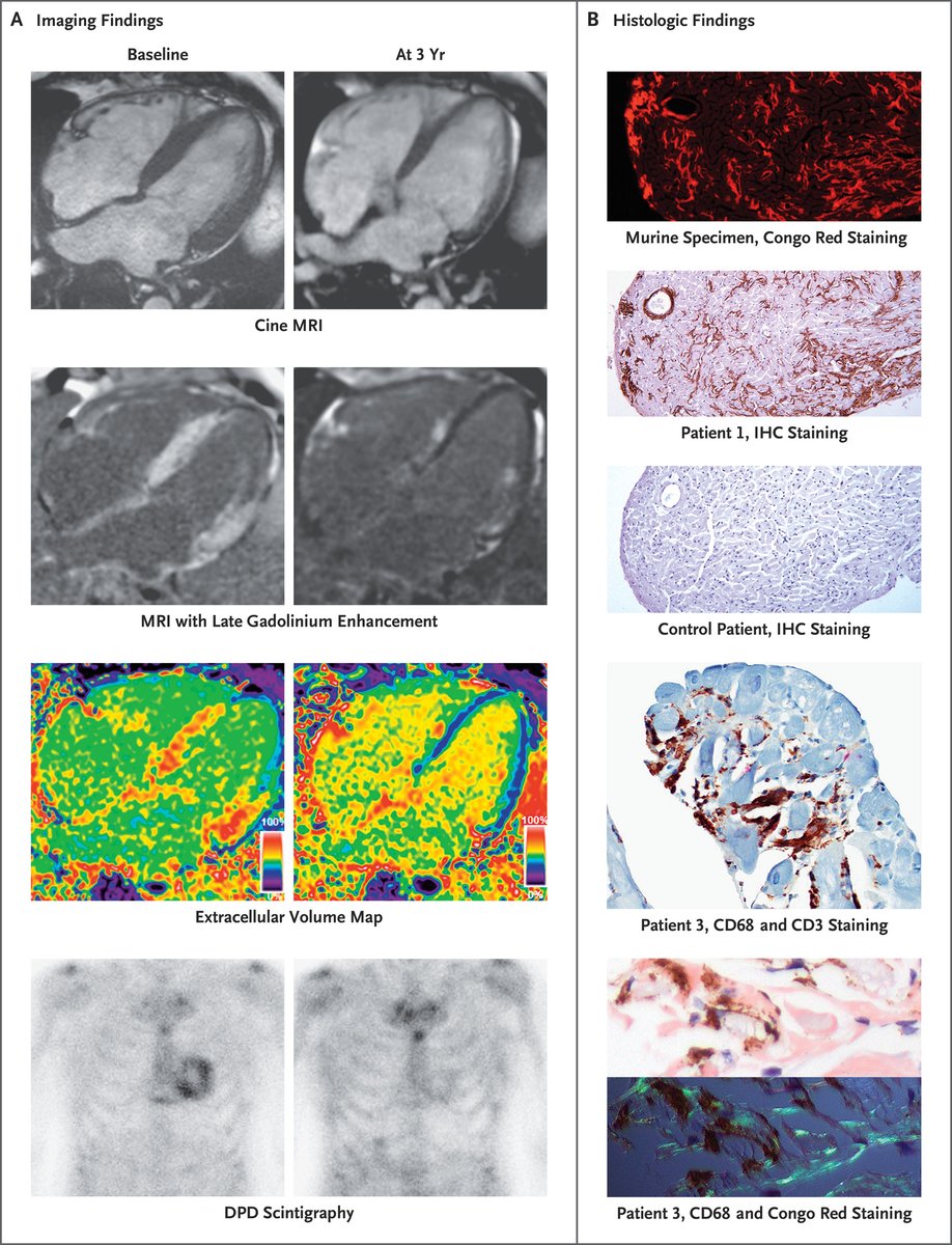 Wow! 3 cardiac #amyloid patients treated with polyclonal IgG #antibodies to human #ATTR. After 3 years, there was nearly complete reversal of disease!  Read here 'Reversal of ATTR Amyloidosis–Related Cardiomyopathy' nejm.org/doi/full/10.10… #cardiotwitter #echofirst #HFpEF