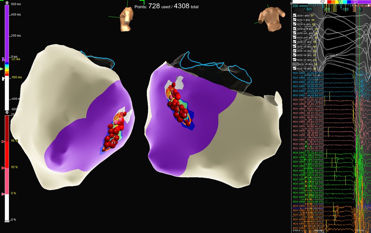 Austin Davies (@value_function) on Twitter photo Congratulations to <a href="/Zo_EP2/">ZoEP</a>, the entire University of Colorado EP Team, and <a href="/CUCardiology/">CU Cardiology</a> on leading the Mountain West into the #TactiFlex era with a very successful first case today! Big smiles & non-inducibility!
#FlexTipTwiceTheGrip
<a href="/madisonkeithEP/">Madison Keith</a> <a href="/The_Curti/">Curtis Lane</a> Congratulations to <a href="/Zo_EP2/">ZoEP</a>, the entire University of Colorado EP Team, and <a href="/CUCardiology/">CU Cardiology</a> on leading the Mountain West into the #TactiFlex era with a very successful first case today! Big smiles & non-inducibility!
#FlexTipTwiceTheGrip
<a href="/madisonkeithEP/">Madison Keith</a> <a href="/The_Curti/">Curtis Lane</a>