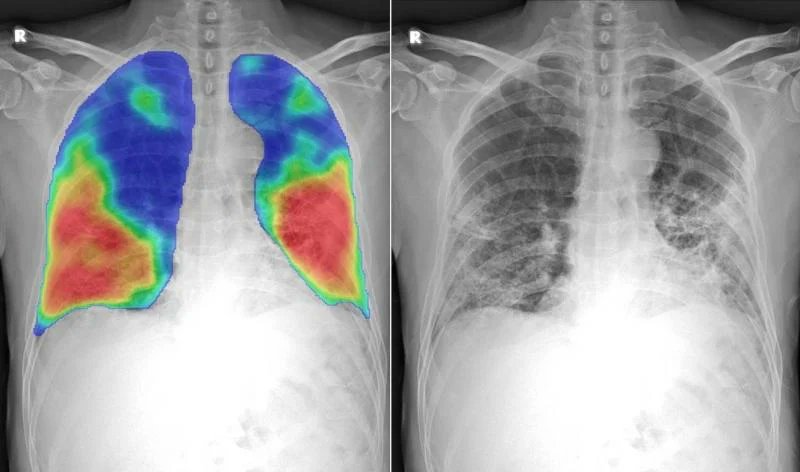 🔍Achieve timely and accurate diagnoses, leading to better treatment outcomes and improved patient survival rates.Our AI technology analyzes lung scans with unprecedented precision, catching even the most subtle signs of cancer.
#AIforHealth #LungCancerDetection #EarlyDiagnosis