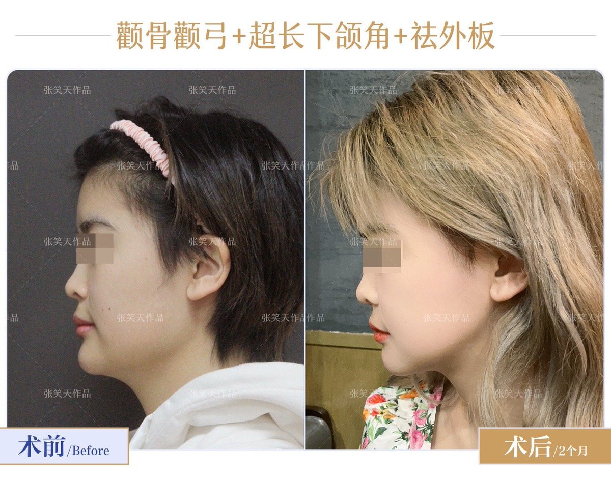 bjhm168's tweet photo. 侧面方大的脸型应该如何设计？
有一类求美者:侧面比正面方，下颌角硬朗，角看上去存在感强，往往是侧脸方大型。

如下面这个求美者，属于侧脸方大。���下颌角向后向下突出，需要设计L型成角截骨，重新塑造一个角。

#下颌角 #磨骨 #颧骨颧弓 https://t.co/qL4hPwR8uI