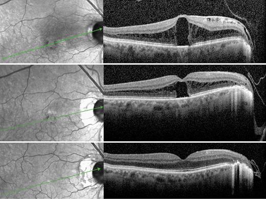 OphthaKarger's tweet photo. Surgical Approaches to Optic Disc Pit Maculopathy: A Clinical Case Series
โก๏ธ https://t.co/IPvaif6ALs
โ๏ธ Pinheiro R.L. et al.
๐ #CaseRepOphthalmol
#OpenAccess https://t.co/syv9drZgsM