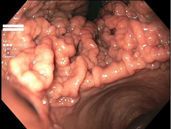 A 64 yo man presented with a h/o diarrhoea for 5 months,occasional abdomen pain,weight loss.Upper GI scopy showed the following finding. What is the likely diagnosis?
#MedTwitter #medicine #MedEd #Clinical  #spotdiagnosis #Health #endoscopy