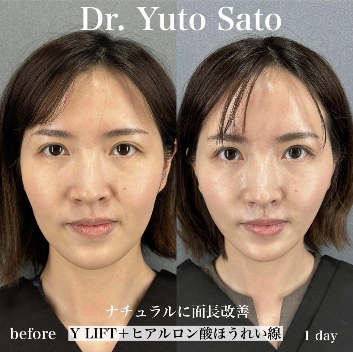 佐藤先生の糸まじですごいと思ってる
骨切りの症例みたい。

ウソみたいだろ…糸だけなんだぜ……

って感じ