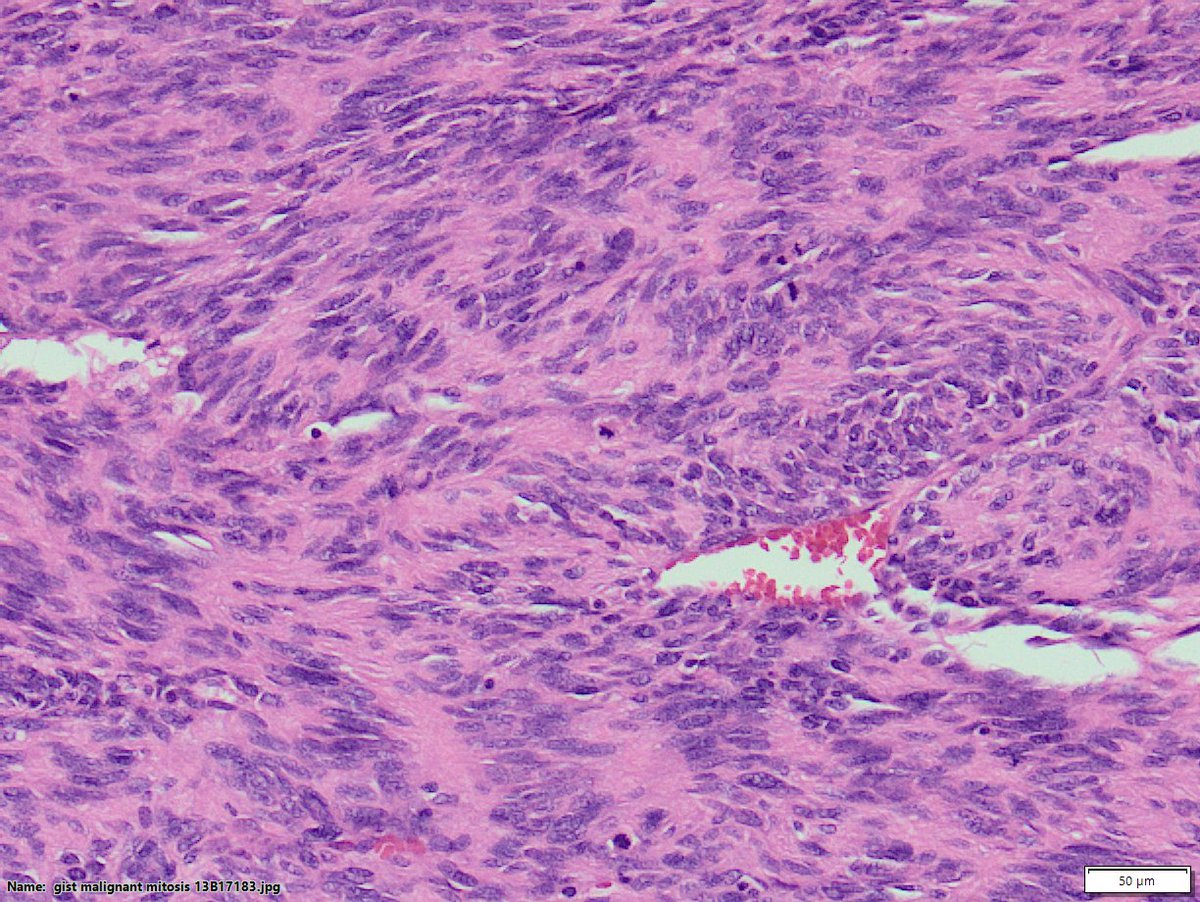 Big mesenteric mass  (mesocolic) ( 15 cm )
Cystic changes made a wide differential
#pathology #gipath
