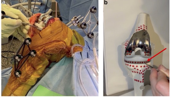 Arthroplasty Today (@arthrotoday) on Twitter photo This surgical technique paper from <a href="/NorthwellHealth/">Northwell Health</a> describes using robotic navigation in the setting of TKA explant and "1.5" spacer placement for PJI. #orthotwitter <a href="/DanoffMD/">Jonathan R. Danoff, MD</a> <a href="/NipunSodhi1/">NipunSodhi, MD</a> <a href="/Max_Willinger1/">Max Willinger, MD</a> <a href="/CoryCalendineMD/">Cory Calendine, M.D.</a>
arthroplastytoday.org/article/S2352-… This surgical technique paper from <a href="/NorthwellHealth/">Northwell Health</a> describes using robotic navigation in the setting of TKA explant and "1.5" spacer placement for PJI. #orthotwitter <a href="/DanoffMD/">Jonathan R. Danoff, MD</a> <a href="/NipunSodhi1/">NipunSodhi, MD</a> <a href="/Max_Willinger1/">Max Willinger, MD</a> <a href="/CoryCalendineMD/">Cory Calendine, M.D.</a>
arthroplastytoday.org/article/S2352-…