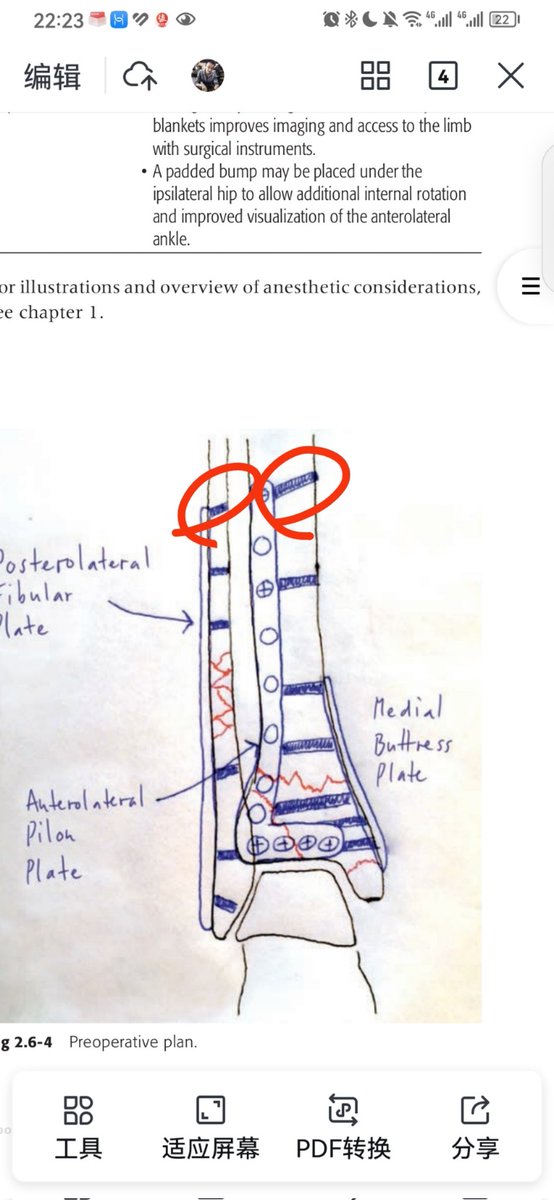 Why is the most proximal screw angled proximally?