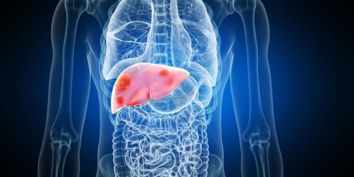 inselgruppe's tweet photo. Study shows: stereotactic #thermalablation offers survival rates comparable to partial liver resection in treating #colorectalcancer #livermetastases. Read more: https://t.co/dWI7UpUiEq
@DanielCandinas @unibern https://t.co/UAyQtr0hXO