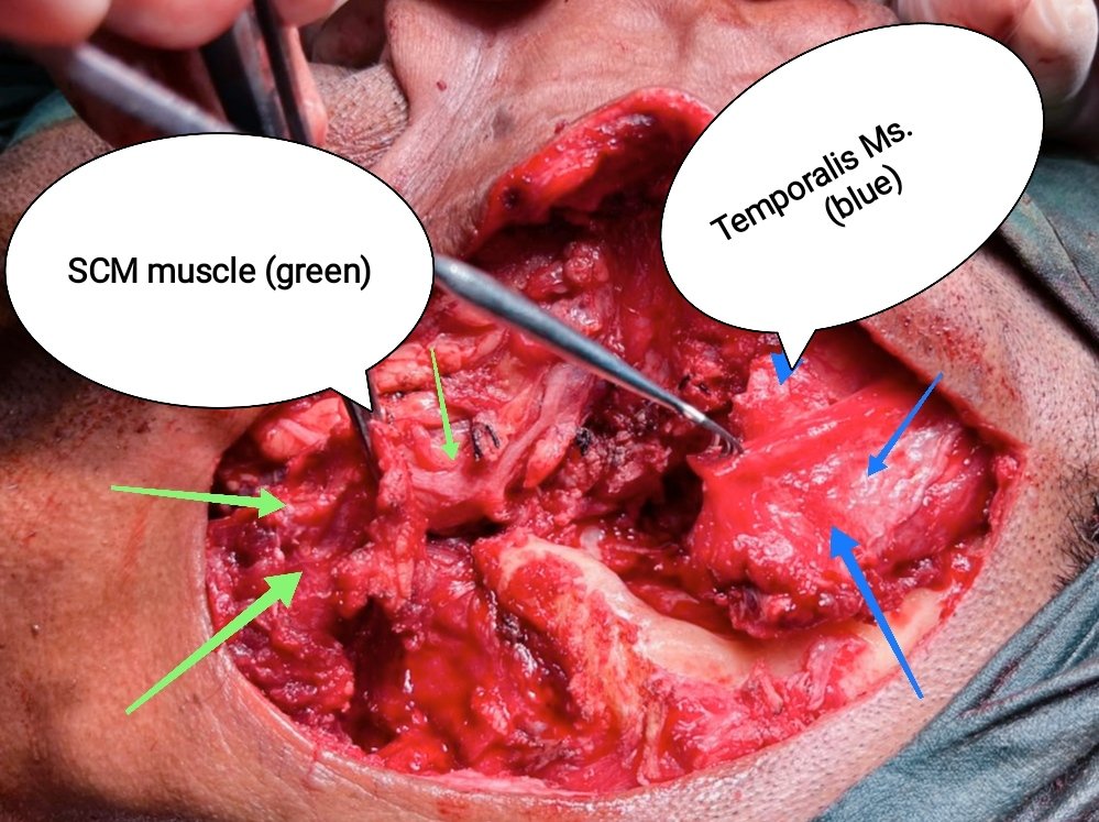 Ent_Faamch's tweet photo. Cul de Sac created post op was covered with Temporalis and SCM muscle (post release) https://t.co/adbnPWjDVu