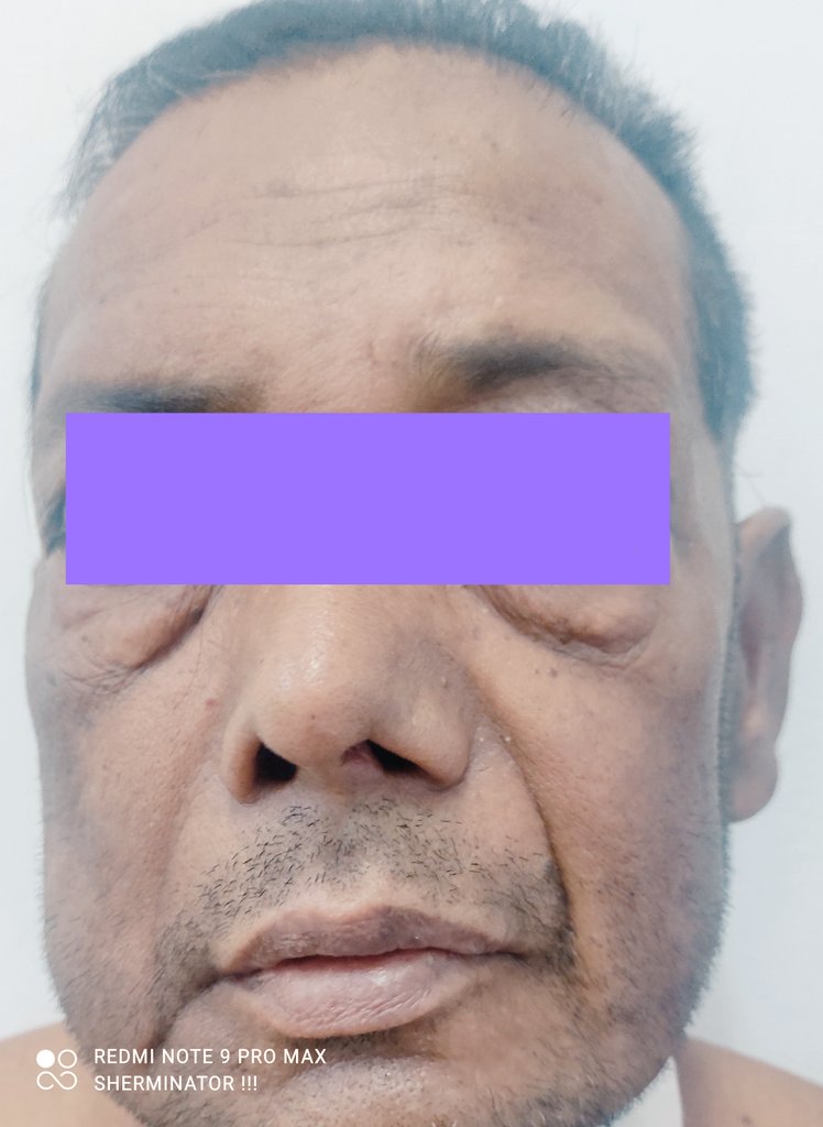Ent_Faamch's tweet photo. Post op patient is doing fine with healthy wound and no obvious facial palsy. https://t.co/Qwt8LMqGv8