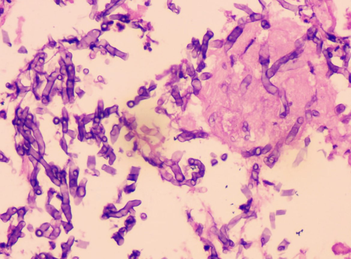 RawiaMo57385655's tweet image. Lung bx 

#thoracic #lungpathology #PathTwitter