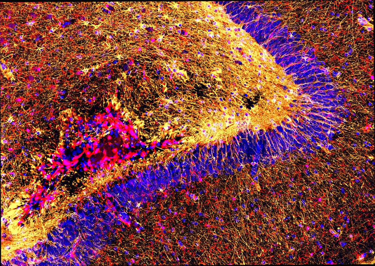 This time, a brain with amyloid peptide, one of the misfolded proteins accumulating in #Alzheimer's Disease. Note the intense inflammatory response in the hippocampus. #fluorescencemicroscopy