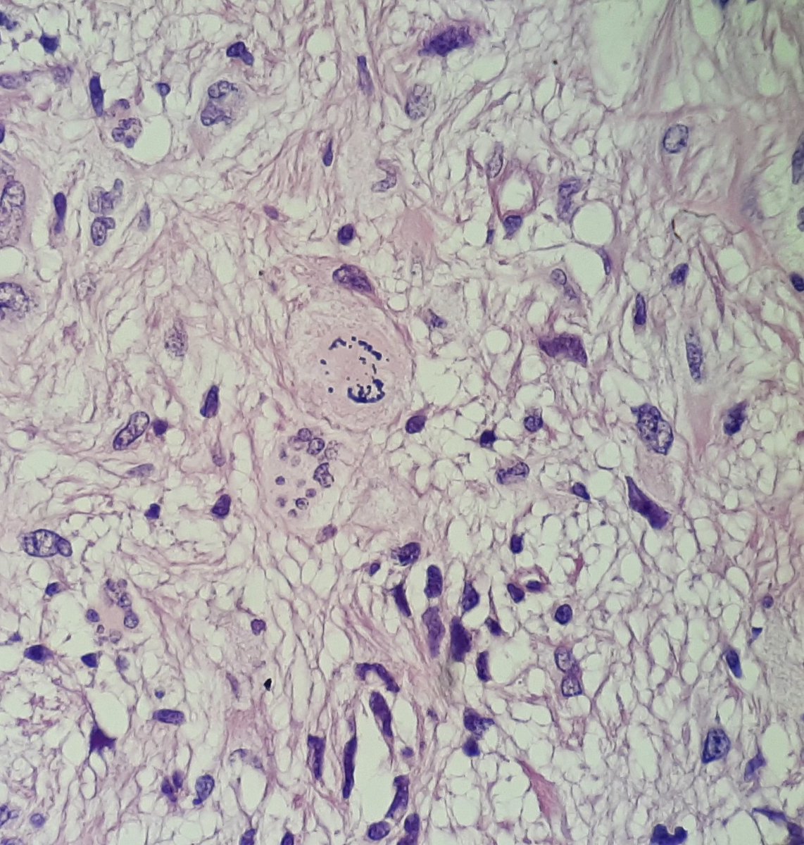 ChiaraSacco13's tweet image. Creutzfeldt cells in a WHO grade 4 Astrocitoma 
#pathology #neuropath #twitterPath